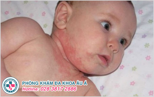 Cẩn thận với chứng viêm da ở trẻ sơ sinh