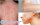 Nổi ban đỏ trên da: Hình ảnh nguyên nhân dấu hiệu cách chữa
