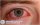 Thủy đậu mọc trong mắt : Nguyên nhân dấu hiệu cách trị