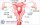 U xơ cổ tử cung là gì ? Nguyên nhân Biểu hiện và Điều trị