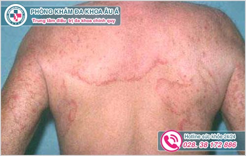 Bị ngứa mẩn đỏ khắp người toàn thân là biểu hiện bệnh nấm da