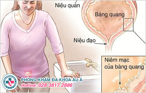 Đi tiểu buốt và đau lưng là dấu hiệu bệnh bệnh viêm bàng quang