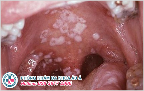 Những mảng trắng trong vòm họng do virus lậu gây ra