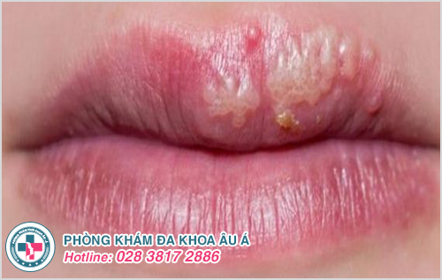 Bệnh lậu ở miệng: Hình ảnh nguyên nhân dấu hiệu cách chữa
