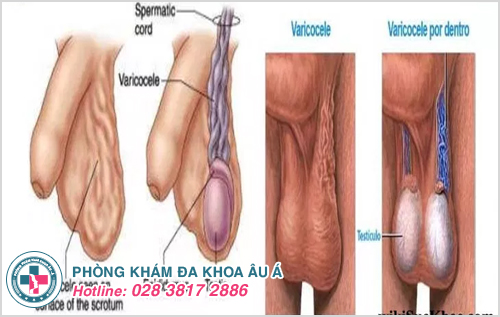 Bệnh sa tinh hoàn là gì? Dấu hiệu, nguyên nhân và cách điều trị