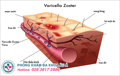 Thủ phạm gây ra bệnh zona chính là vi rút Varicella Zoster – loại vi rút gây bệnh thủy đậu