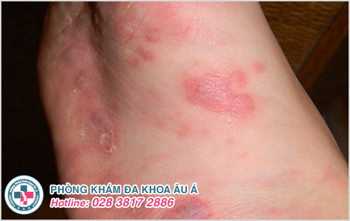 Hình ảnh bệnh Zona ở lòng bàn chân