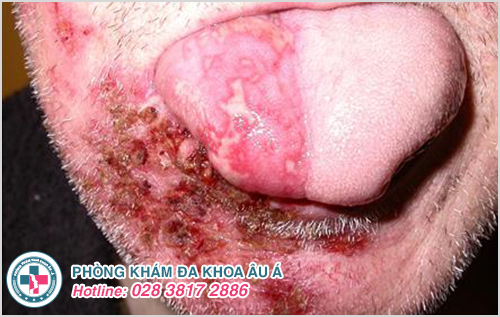 Hình ảnh bệnh Zona ở miệng gây lở loét