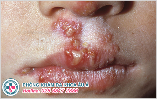 Một số hình ảnh bệnh zona ở miệng