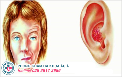 Bệnh zona ở tai: Hình ảnh nguyên nhân dấu hiệu cách chữa