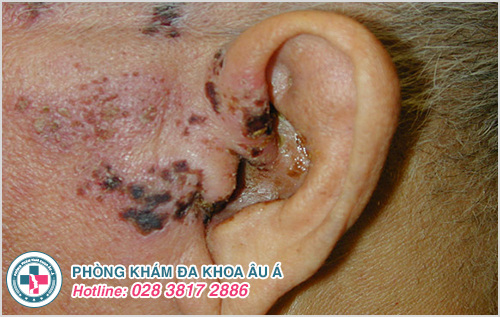 Một số hình ảnh bệnh zona ở tai