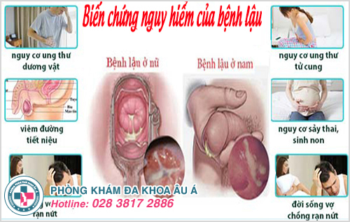 Những biến chứng nguy hiểm bệnh lậu gây ra cho cả nam giới và phụ nữ