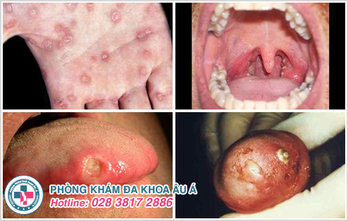 Vi khuẩn Neisseria Gonorrhoeae/ Gonococcus gây ra bệnh lậu tại các vị trí khác nhau