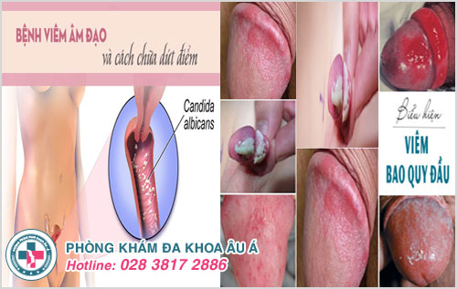 Viêm âm đạo và viêm bao quy đầu gây ra các vết sưng đỏ, lở loét ở cơ quan sinh dục nam và nữ giới