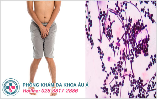 Nguyên nhân  do nấm Candida albicans gây ra bệnh ở bộ phận sinh dục nam