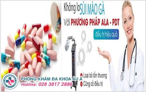 Điều trị hiệu quả bệnh sùi mào gà ở lưỡi bằng thuốc và phương pháp ALA- PDT