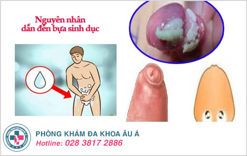 Bựa sinh dục có nguy hiểm không?