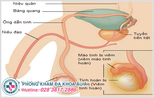 Tình trạng viêm tinh hoàn gây sưng đau, nhức nhối ở bên ngoài vùng bìu