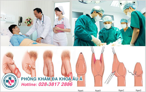 cắt bao quy đầu có tốn kém không