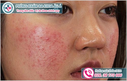 Da mặt nổi sần nhưng không ngứa là dấu hiệu bệnh gì?