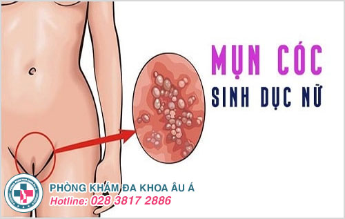 Biểu hiện mụn cóc sinh dục ở nữ giới