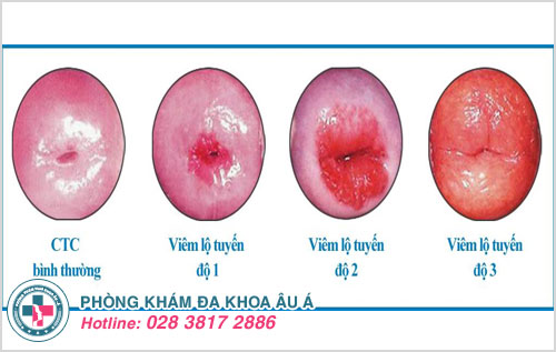 Viêm lộ tuyến cổ tử cung qua mỗi cấp độ