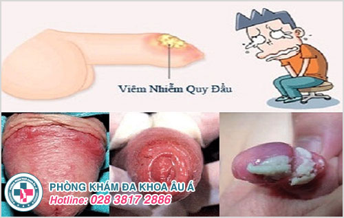 Đau nhức vùng kín là biểu hiện của bệnh viêm bao quy đầu ở nam giới