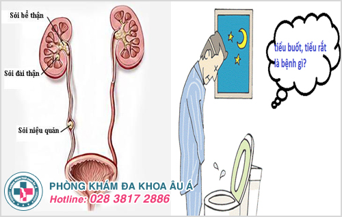 Tiểu buốt tiểu rắt là có thể dấu hiệu bệnh sỏi tiết niệu