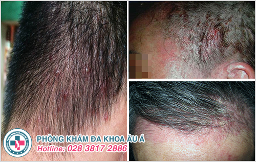 Dị ứng da đầu : Hình ảnh nguyên nhân dấu hiệu cách điều trị