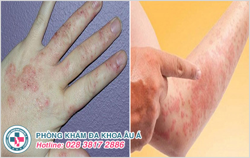 Dị ứng da tay : Hình ảnh nguyên nhân dấu hiệu cách điều trị