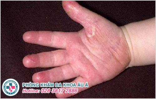 Dị ứng da tay : Hình ảnh nguyên nhân dấu hiệu cách điều trị