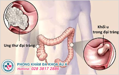 Đi vệ sinh ra máu tươi ở hậu môn