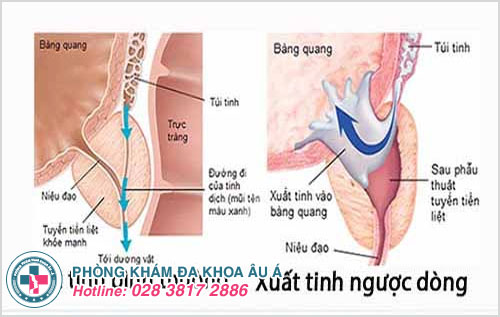 địa chỉ chữa xuất tinh ngược dòng tại tphcm