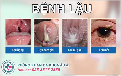 Điều trị bệnh lậu bằng phương pháp DHA có tốt không?