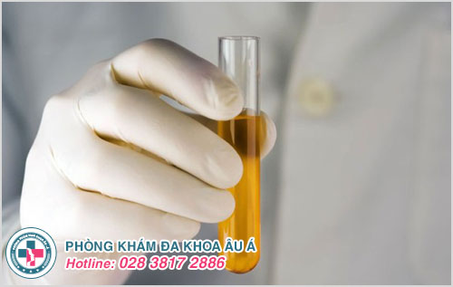 Đoán bệnh qua nước tiểu màu vàng đục