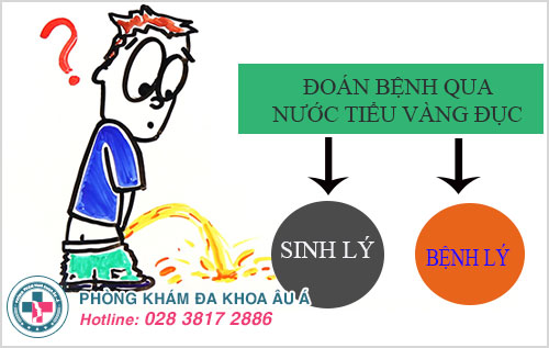 Đoán bệnh qua nước tiểu màu vàng đục