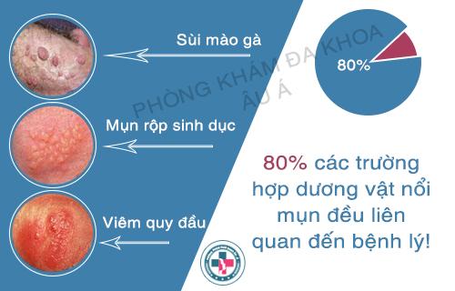 Cảnh báo: Những điều bạn phải biết về dương vật nổi mụn