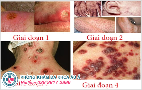 Bệnh giang mai biểu hiện khác nhau qua mỗi giai đoạn