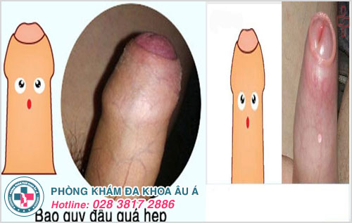 hẹp bao quy đầu có dẫn đến ung thư dương vật không