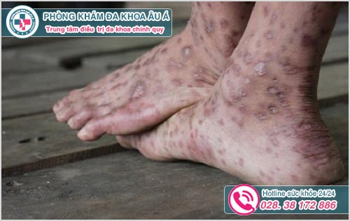 hình ảnh các bệnh về da chân thường gặp