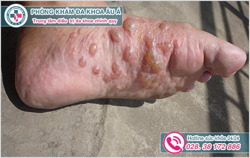 hình ảnh các bệnh về da chân thường gặp