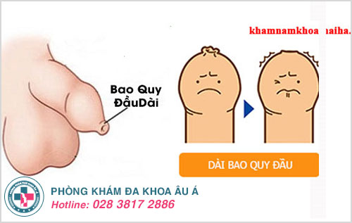 hình ảnh trước và sau khi cắt bao quy đầu