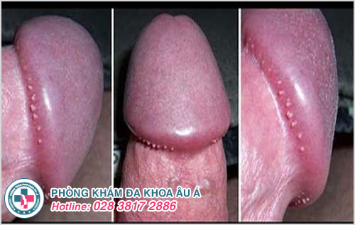 Hình ảnh gai sinh dục ở nam giới