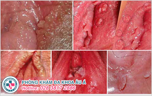 Gai sinh dục ở nam và nữ giới