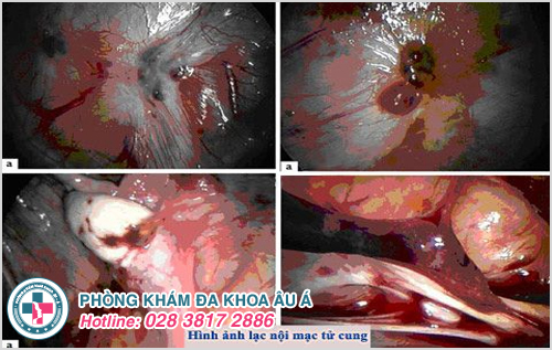 　　Hình ảnh siêu âm lạc nội mạc tử cung đầu dò âm đạo