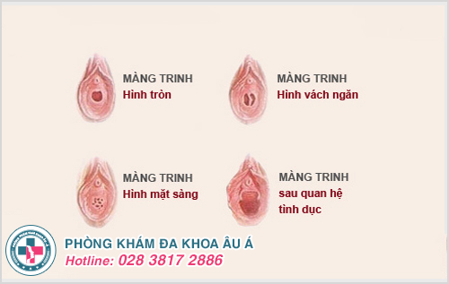 Màng trinh có thể tự lành lại sau khi bị rách không?