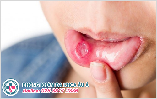 Bệnh giang mai ở miệng: Hình ảnh Nguyên nhân Dấu hiệu Cách chữa
