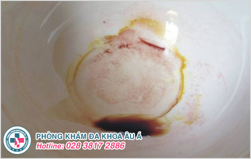 Hình ảnh tinh trùng vón cục màu nâu