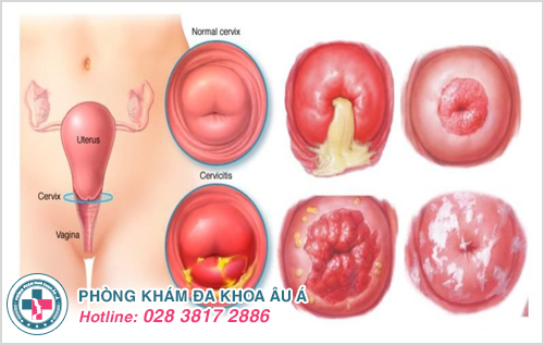 Một số hình ảnh viêm phụ khoa ở phụ nữ do các bệnh lý gây ra