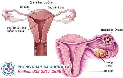 hình ảnh viêm phụ khoa ở phụ nữ